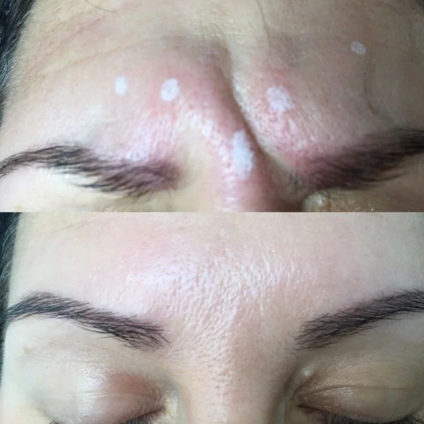Botox - before and after