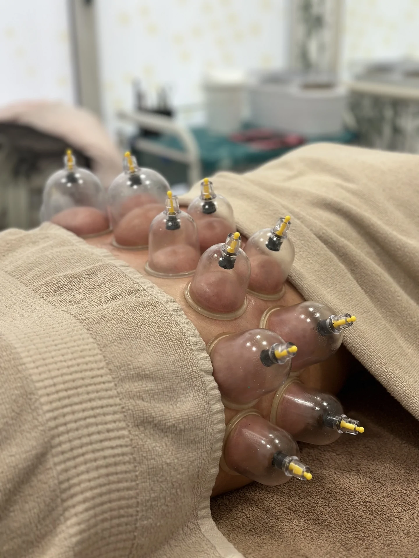Cupping massage at Sofiamed