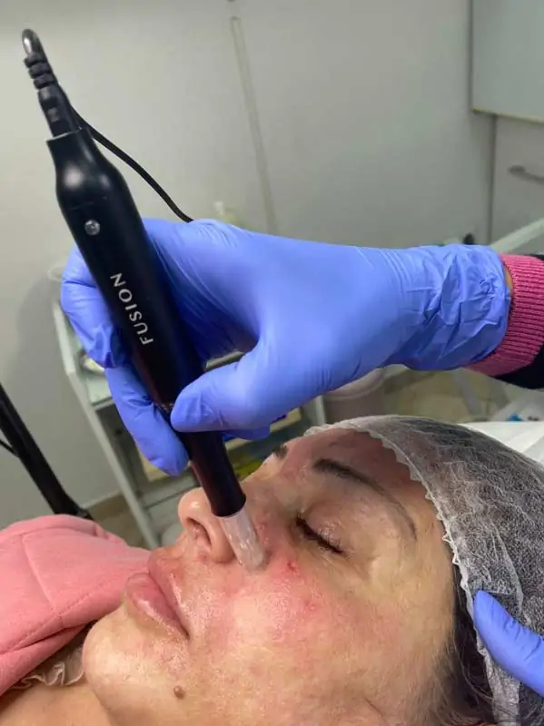 Dermapen mesotherapy Dermapen mesotherapy