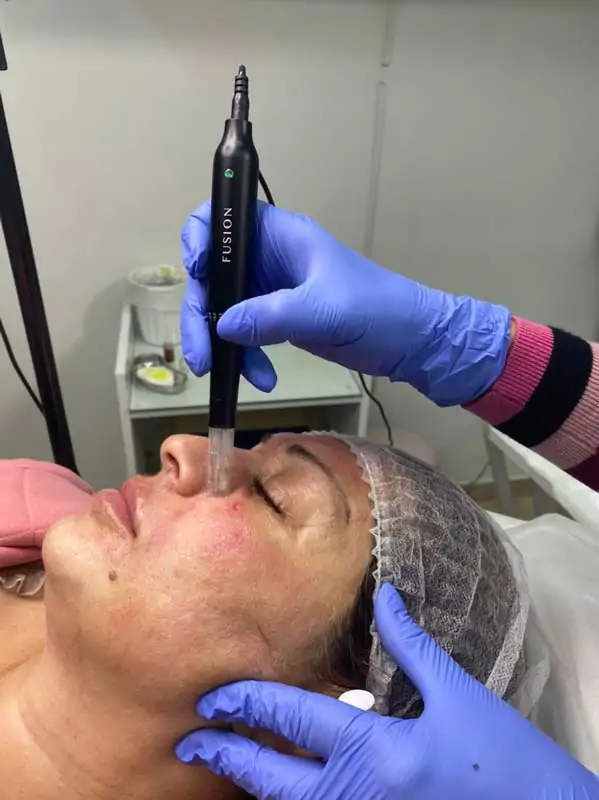 Dermapen mesotherapy Dermapen