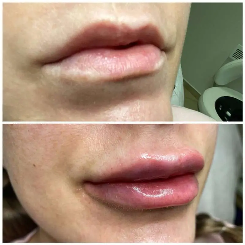 Lips Correction and Filling