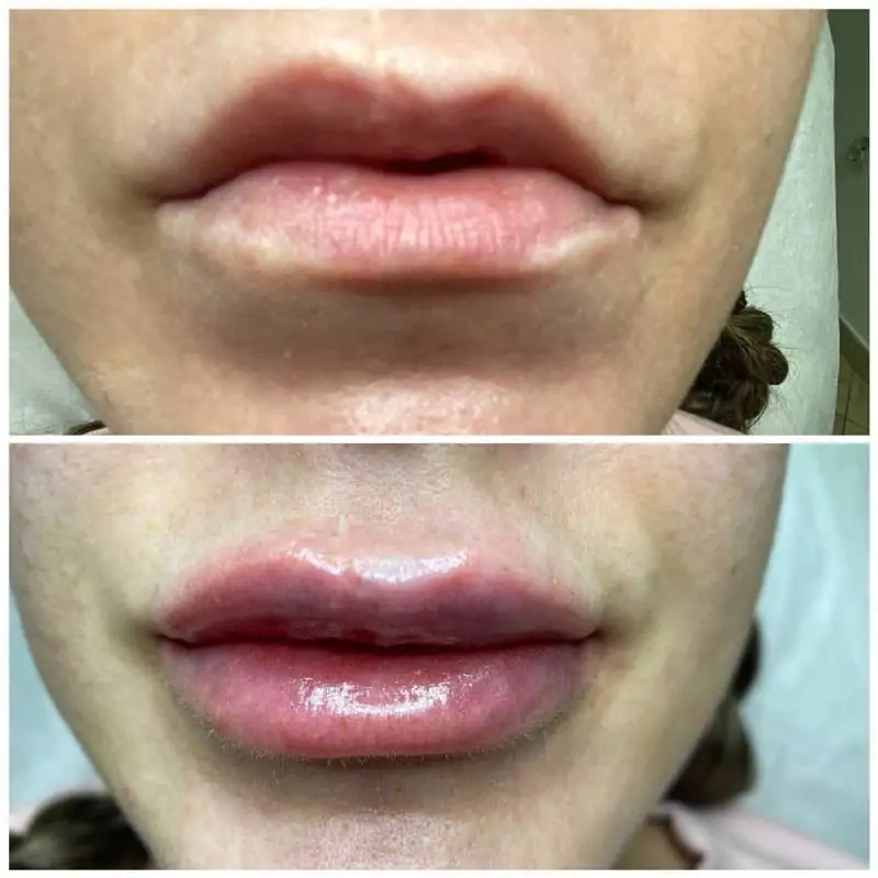 Lips Correction and Filling