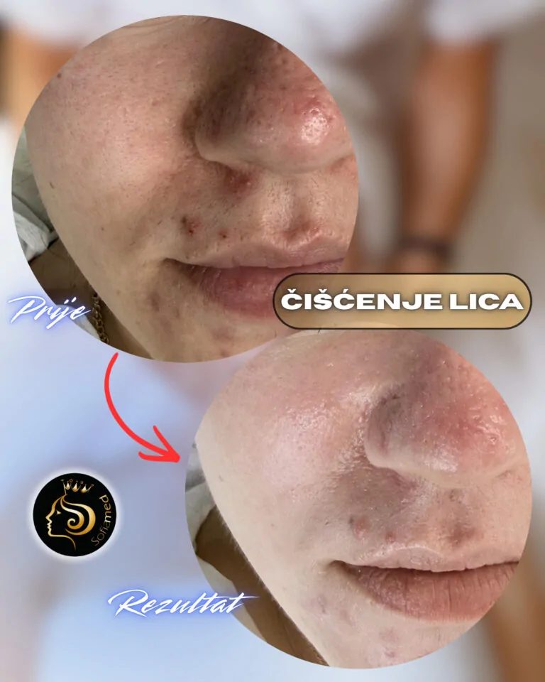Čišćenje lica
